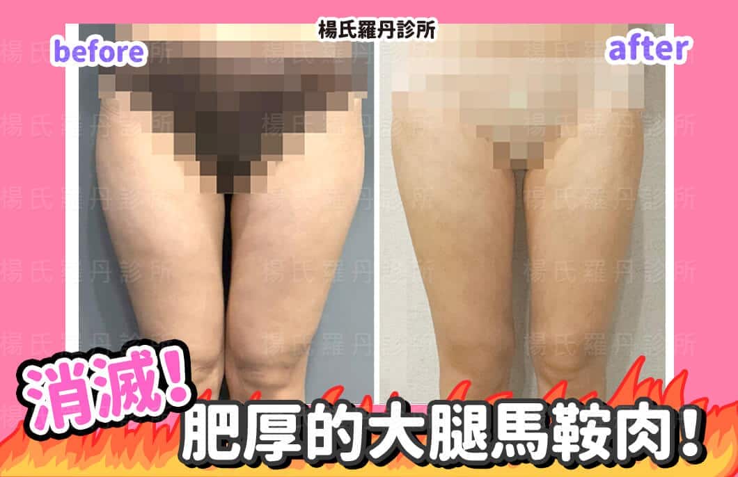 【雷射減脂】消滅！肥厚的大腿馬鞍肉！
